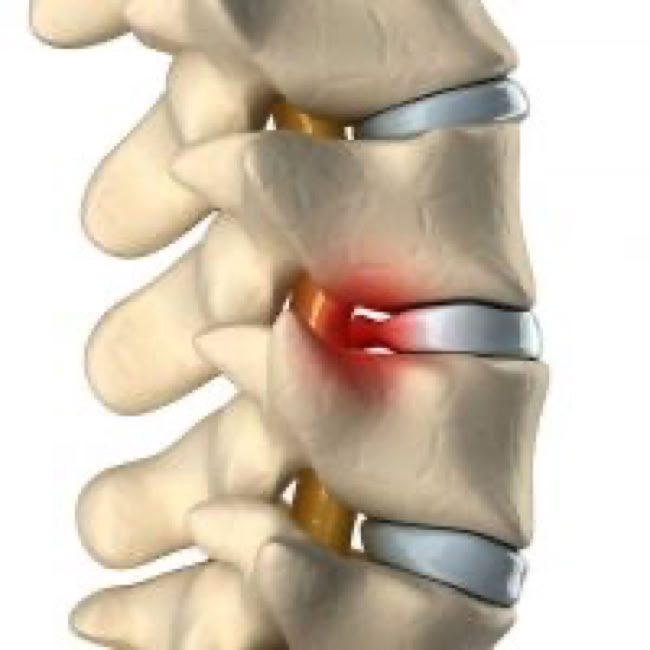 compressed nerve due to disc herniation