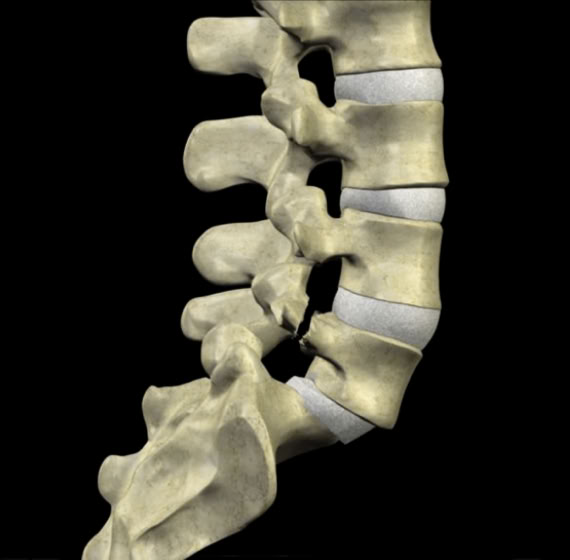 spondylolisthesis picture