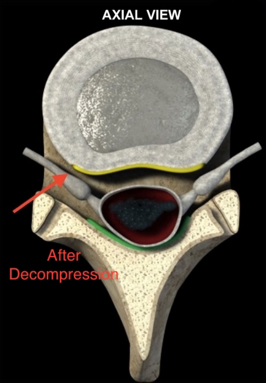 Disc bulge after decompression