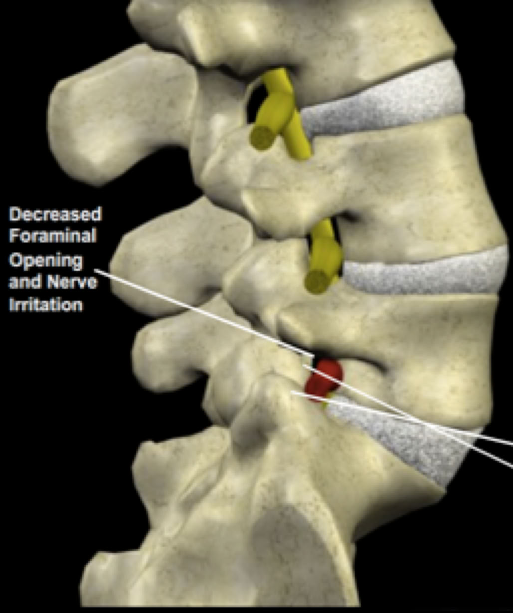Facet Syndrome