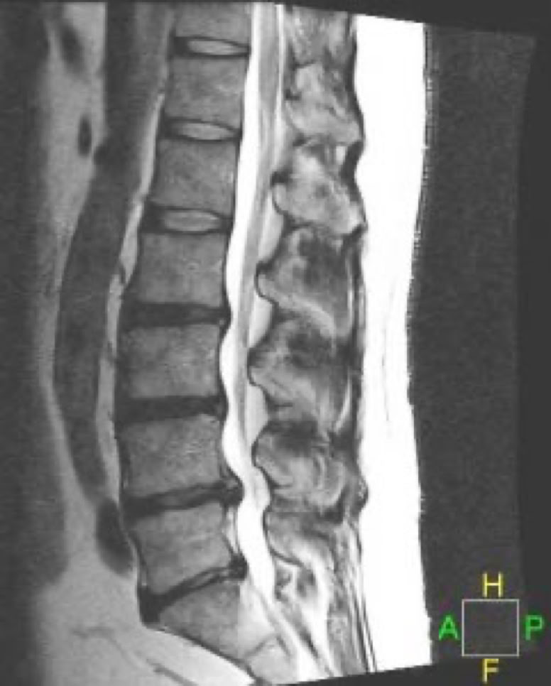 disc hernaition on MRI